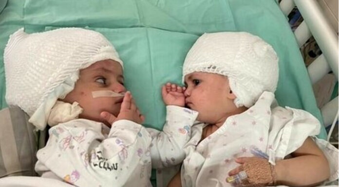 Що відомо про зрощених головами сіамських близнюків, яких рятували від загибелі кращі хірурги світу
