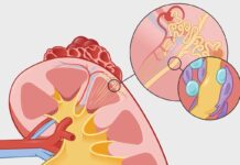 Глобальне зростання захворювань нирок: зростаюча криза охорони здоров’я
