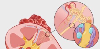 Глобальне зростання захворювань нирок: зростаюча криза охорони здоров’я