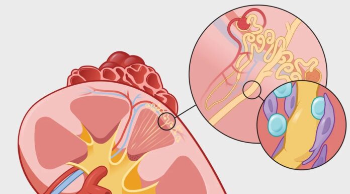 Глобальне зростання захворювань нирок: зростаюча криза охорони здоров’я