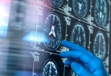 Новий огляд Cochrane: препарати проти амілоїду при хворобі Альцгеймера практично не приносять клінічної користі