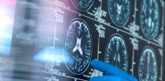 Новий огляд Cochrane: препарати проти амілоїду при хворобі Альцгеймера практично не приносять клінічної користі