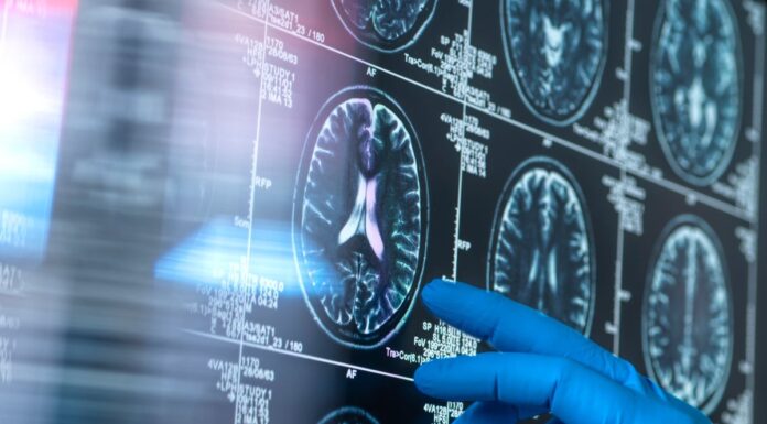 Новий огляд Cochrane: препарати проти амілоїду при хворобі Альцгеймера практично не приносять клінічної користі